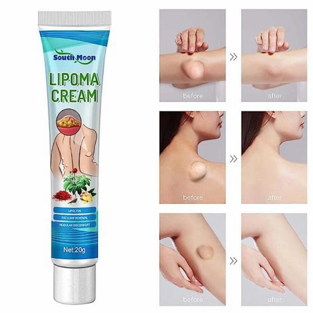 South Moon™ Lipoma Treatment Ointment